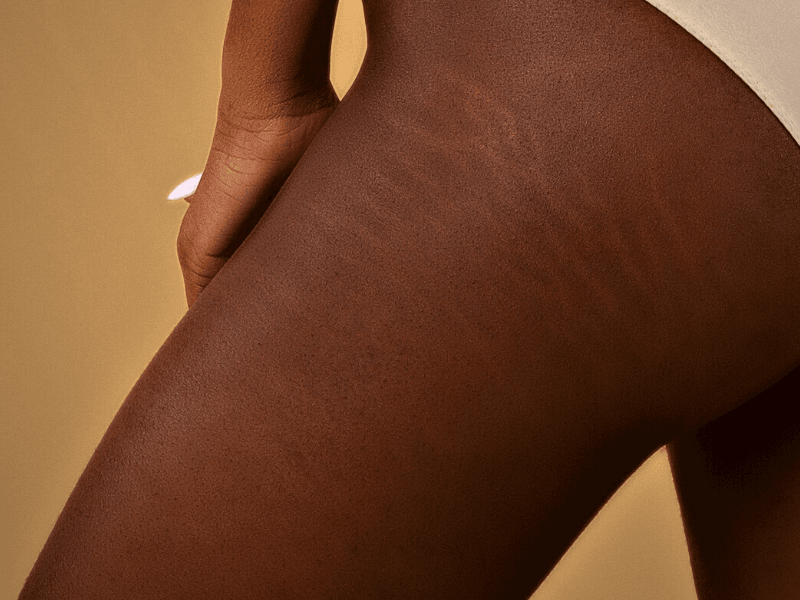 Stretch marks on thighs