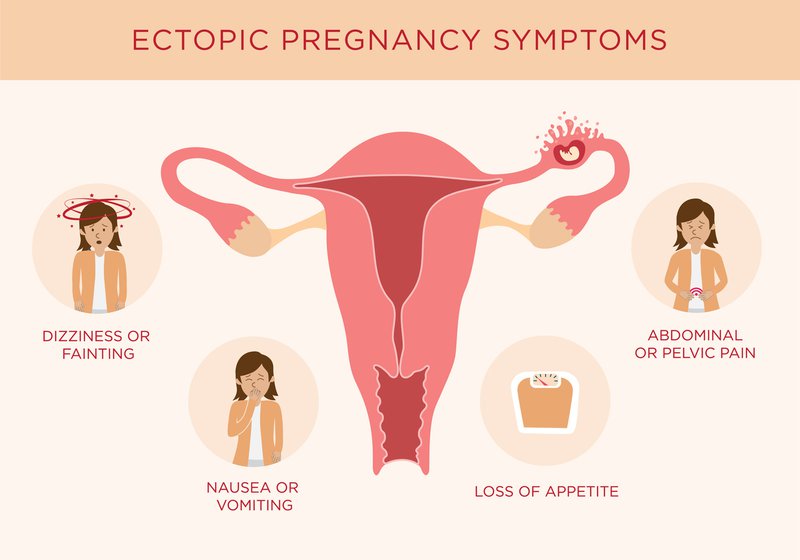 Infographic of ectopic pregnancy symptoms